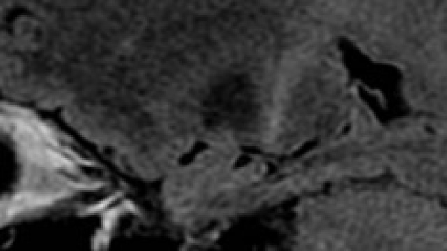 Una PET come diagnosi precoce per la SLA