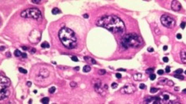 La Proteina Bioingegnerizzata arresta la metastasi