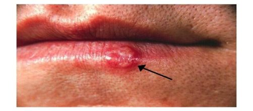 grano en el labio con rojez y pus