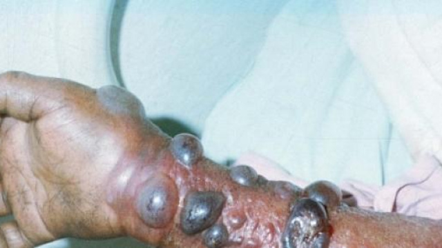 Gli effetti del virus Ebola.