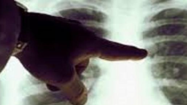  Per le donne pi&ugrave; letale il cancro ai polmoni
