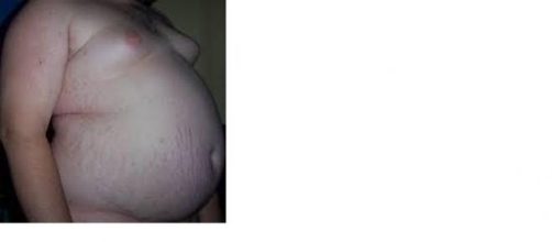 Obesity is a growing issue across the world