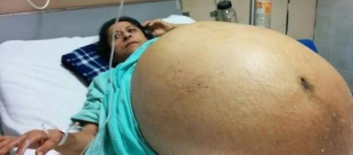 Tumor de 60 kg &eacute; retirado de mulher mexicana
