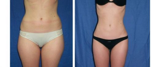 Indicada para toda zona de adiposidad localizada