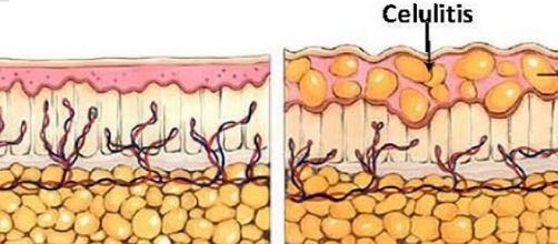 Acum&oacute;los de Celulitis de forma intensa