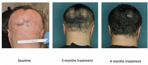 Paciente tratado con ruxolitinib