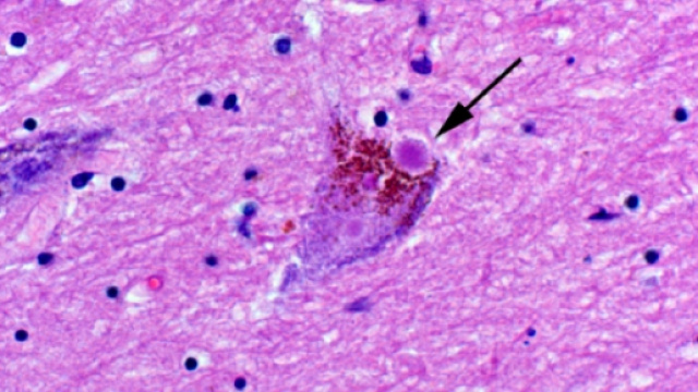 Un corpo di Lewy (freccia) in un neurone