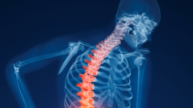 Osteoporosi, prevenzione e cura