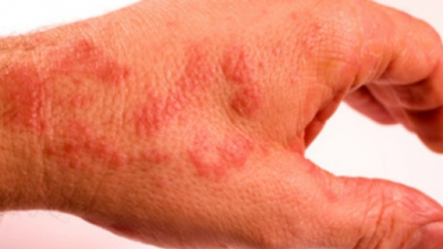 Segni di dermatite apparsi sulle mani