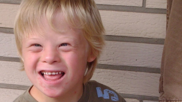 Un bambino con sindrome di Down