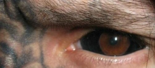 Resultado de um Eyeball Tattoo