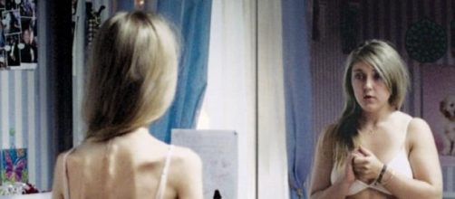 Anorexia, un caso extremo de delgadez
