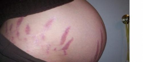 Estrias vermelhas: mais comum na gravidez