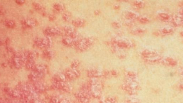 Un esempio evidente di Psoriasi