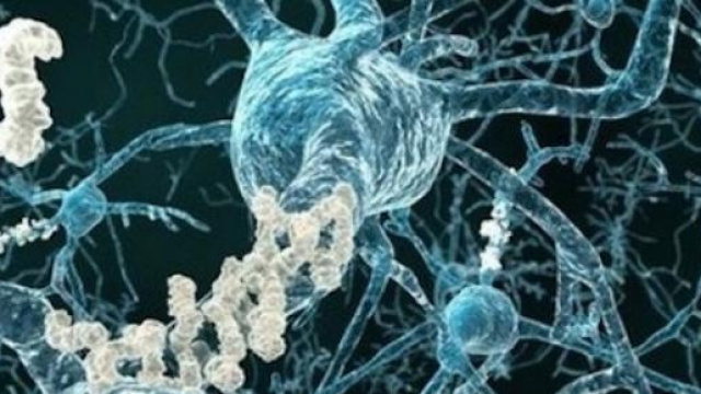 Placca senile formata da accumulo di beta-amiloide