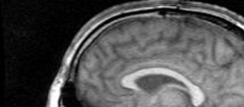 El cerebro visto por resonancia magn&eacute;tica