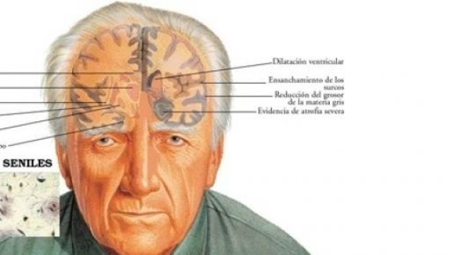 Psicopatologia del Morbo di Alzheimer.