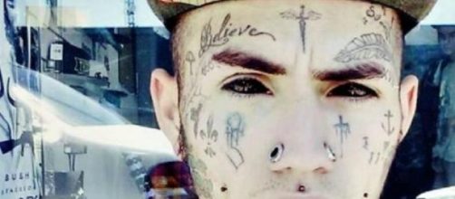 Bruno teve que retirar implante de silicone 