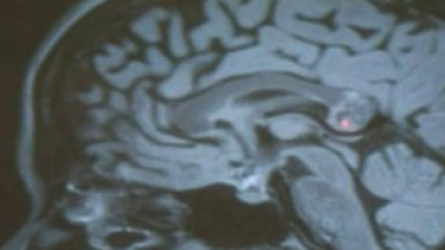 Un gemello sconosciuto chiamato teratoma.