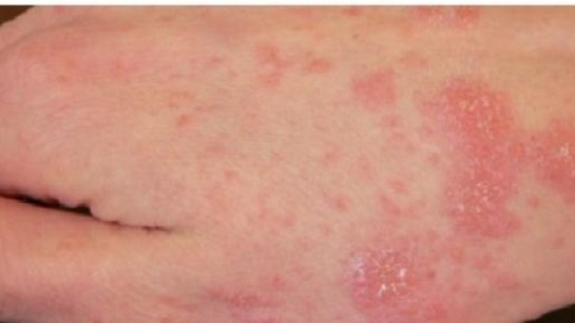  Immigrati clandestini: incubo scabbia in Italia?