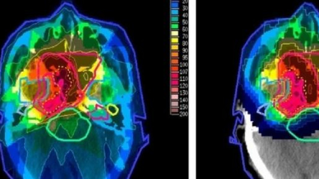 Terapia protonica, la nuova radioterapia
