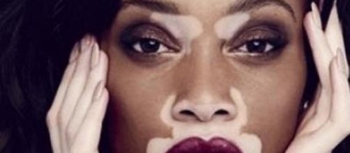 Winnie Harlow, modelo y portavoz de la enfermedad