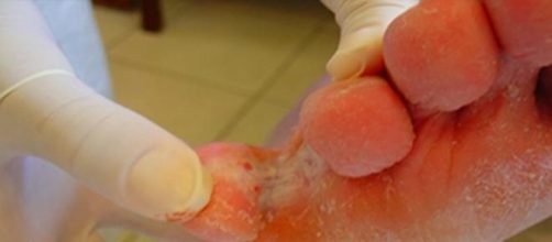 A imagem mostra como o p&eacute;-de-atleta &eacute; desagradavel