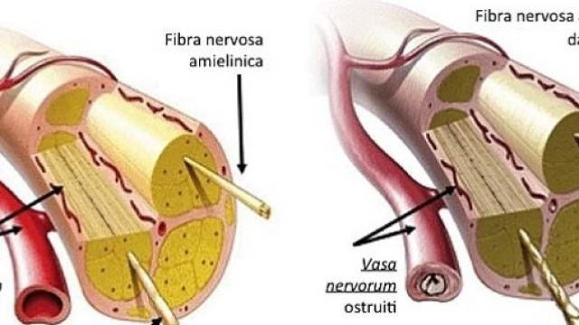 Nervo sano (sx) vs neuropatia diabetica (dx)