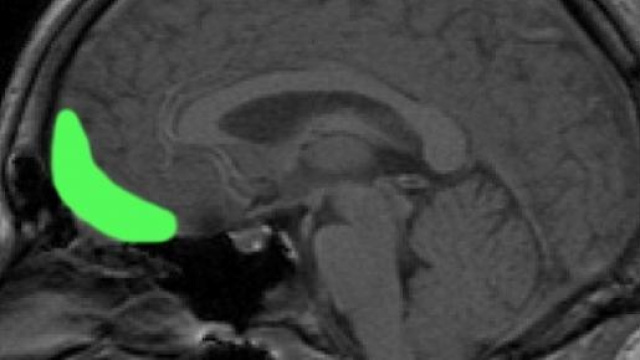 Corteccia orbitofrontale su piano sagittale