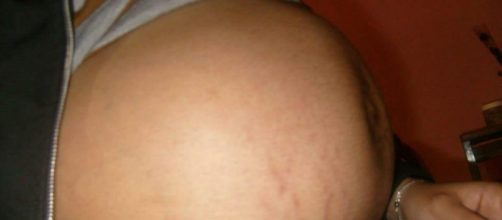 Embarazo de 36 semanas de gestaci&oacute;n.