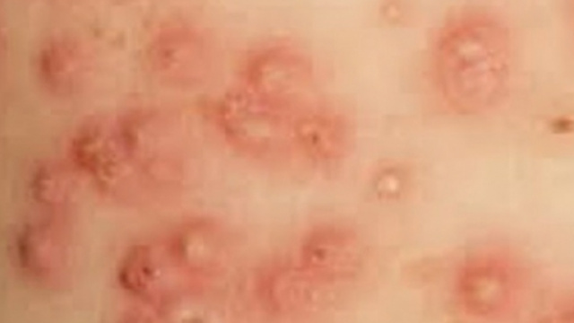 Alcuni casi evidenti di Impetigine