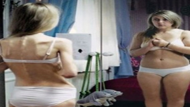 L'anoressia colpisce 2 milioni di italiani