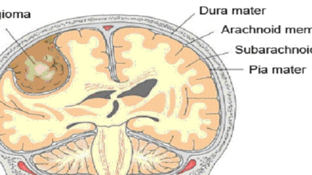 Meningioma Trattabile con Tecnica Alternativa