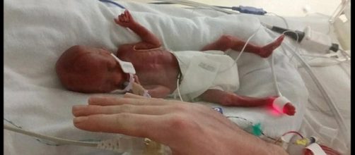 beb&ecirc; de 400 g surpreende a medicina