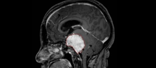 Esperanza terap&eacute;utica para el c&aacute;ncer cerebral
