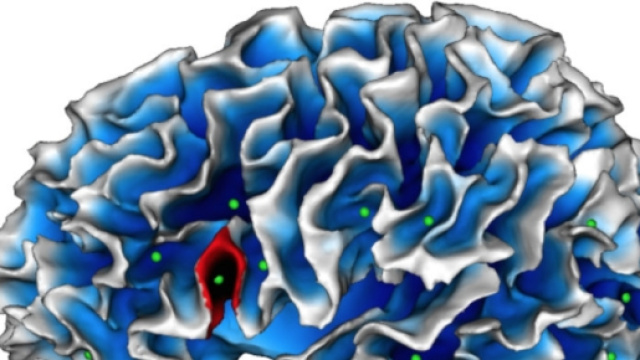 La zona del cervello anomala nell'autismo
