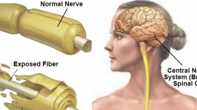 Nervo sano e danneggiato dalla sclerosi multipla