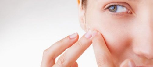 Remedios naturales contra el acn&eacute;
