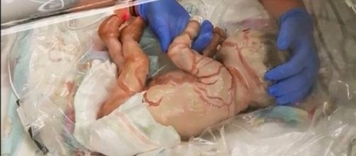 Harper Foy nasceu com Ictiose Arlequim (Cr&eacute;dito: YouTube/ZonaVideoInspiratif)