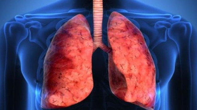 Tumore ai polmoni, dall'Australia arriva Keytruda