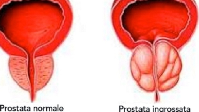 Il tumore alla prostata &egrave; quello a maggiore incidenza nei maschi. In arrivo un nuovo test di screening: 4K Score.