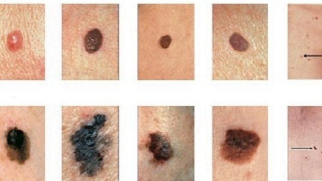 Seguendo le indicazioni suggerite dalla sigla ABCDE si pu&ograve; identificare un melanoma in una fase precoce.