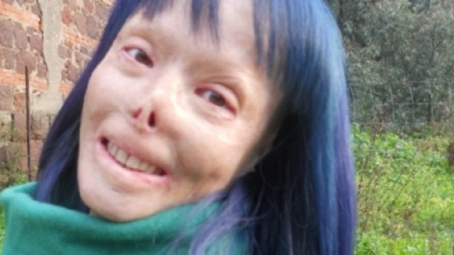 Valentina Pitzalis, sfigurata dopo essere stata bruciata