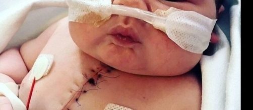 Imagem de beb&ecirc; que nasceu com apenas metade do cora&ccedil;&atilde;o.
