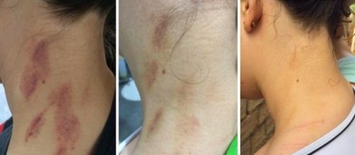 Aprenda como retirar marcas de chup&atilde;o