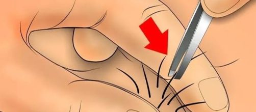 Ilustra&ccedil;&atilde;o de retirada de um pelo encravado com uso de pin&ccedil;a