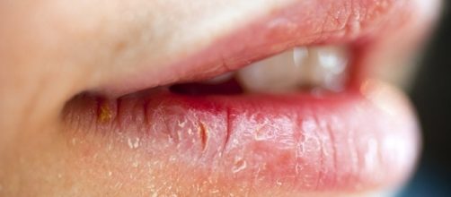 L&aacute;bios ressecados podem causar s&eacute;rias doen&ccedil;as.