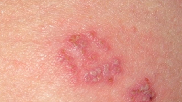 In arrivo un nuovo vaccino contro l'Herpes Zoster, il virus responsabile del Fuoco di Sant'Antonio.