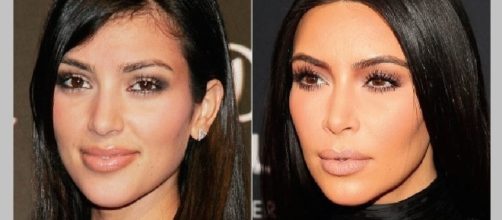 Bichectomia - O que &eacute;? Qual o Pre&ccedil;o? Quais os resultados? - portalbebes.net