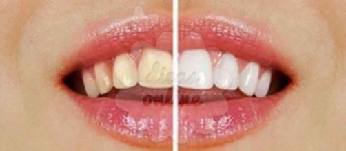 Dentes claros sem ir ao dentista? Sim! &Eacute; poss&iacute;vel!